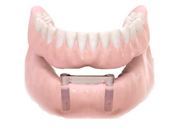 Bedenken Besnoeiing Puur Alle tanden vervangen | Dentsply Sirona