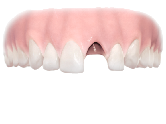 Eén tand vervangen - Dentsply Sirona